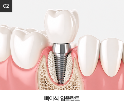 뼈이식 임플란트