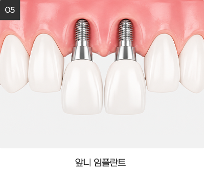 앞니 임플란트