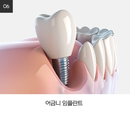 보험 임플란트