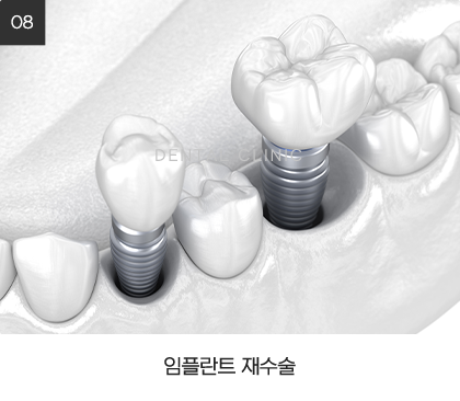 임플란트 재수술